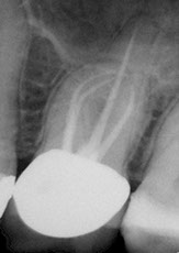 Successful root canal treatment of a complicated molar